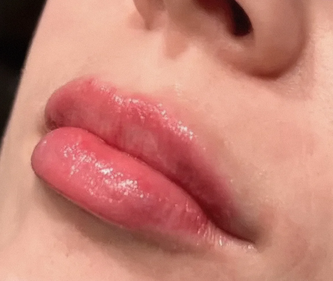 Lips after dermal filler treatment