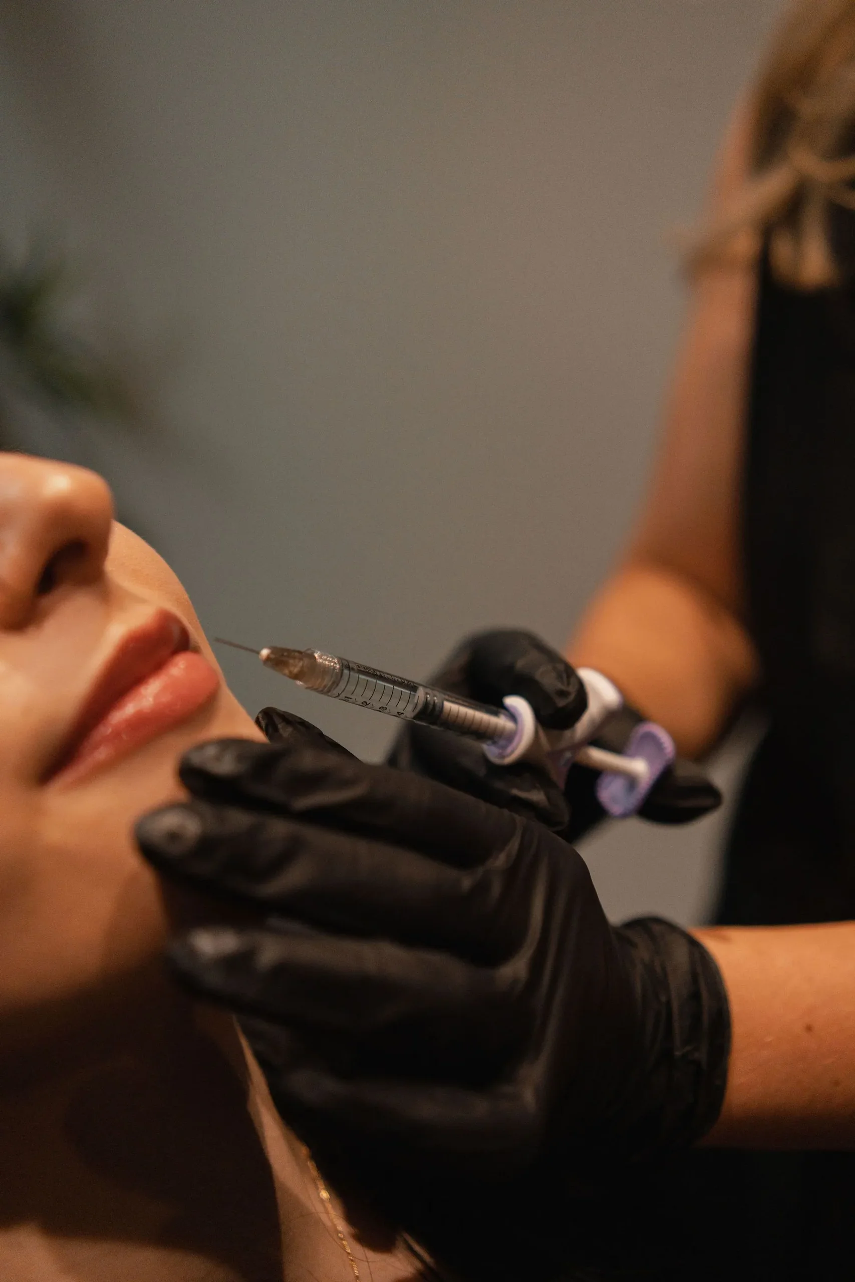 Dermal filler treatment at Uplift Aesthetics