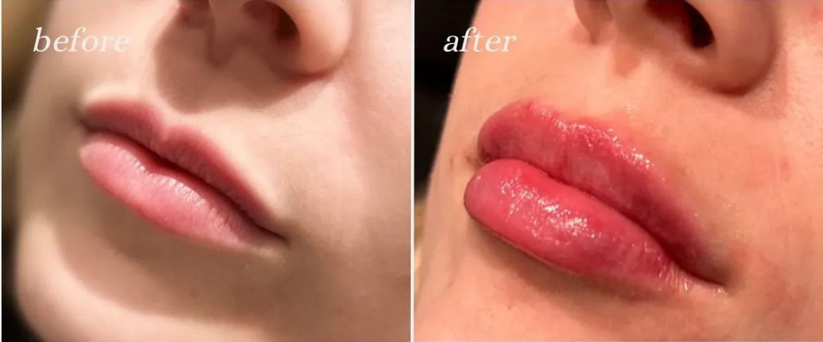 Before and after image of dermal filler procedure